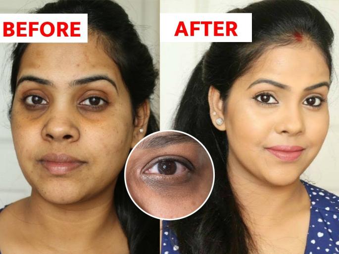 Dark circles: See 3 ways to reduce dark circles, easy home remedies must try | Dirk circles : डोळ्याखालील काळ्या त्वचेचे नेमके काय करावे? पाहा डार्कसर्कल्स कमी करण्यासाठी ३ उपाय