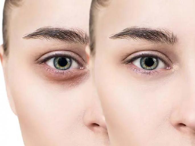 fed-up-due-to-dark-circles-try-these-home-remedies-and-get-rid-of-it | 'डार्क सर्कल्स' मुळे त्रस्त आहात? करुन पहा 'हे' घरगुती उपाय fed-up-due-to-dark-circles-try-these-home-remedies-and-get-rid-of-it | 'डार्क सर्कल्स' मुळे त्रस्त आहात? करुन पहा 'हे' घरगुती उपाय