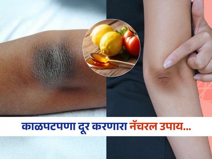 No bleach, no cream...this natural remedy will remove dark elbows and knees; results in 3 days | ना ब्लीच, ना क्रीम...कोपर आणि गुडघ्यांचा काळपटपणा दूर करणारा सोपा 'हा' नॅचरल उपाय, ३ दिवसात रिझल्ट