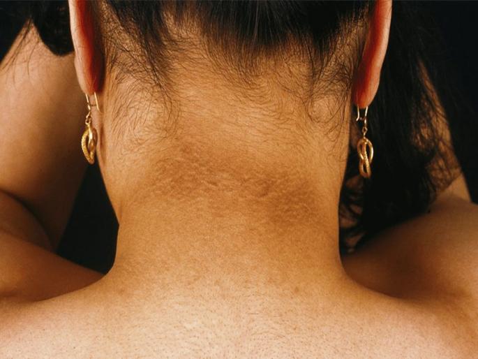 Tips to get rid of dark neck instantly | मानेवरील काळ्या डागांना हैराण आहात? या घरगुती उपायांनी दूर करा काळेपणा! 