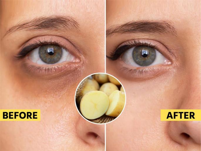 How to reduce dark circles under eyes naturally at Home 15-minute home trick to brighten dull skin and tired eyes | चेहरा निस्तेज, डोळ्यांखाली काळी वर्तुळं? १ सोपी ट्रिक- १५ मिनिटांत त्वचा उजळेल, सूजही होईल कमी