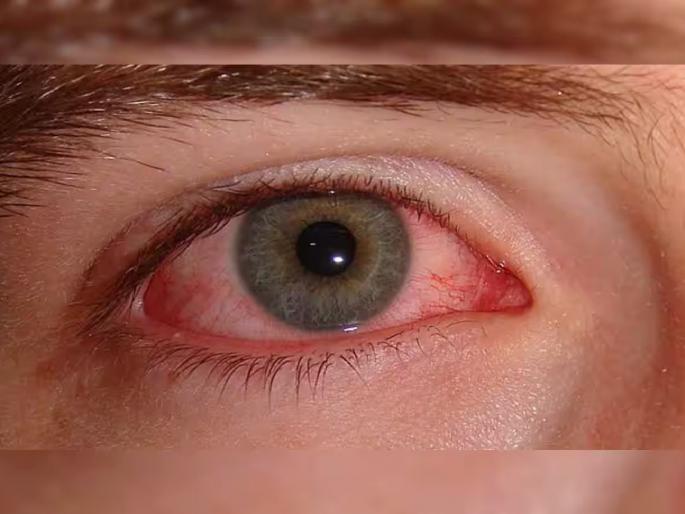 health alert : Conjunctivitis spreading widely from schools in nagpur | घराघरांत साथ, उपस्थितीवर परिणाम; शाळेतून मोठ्या प्रमाणात पसरतोय कंजेक्टीव्हायटीस health alert : Conjunctivitis spreading widely from schools in nagpur | घराघरांत साथ, उपस्थितीवर परिणाम; शाळेतून मोठ्या प्रमाणात पसरतोय कंजेक्टीव्हायटीस