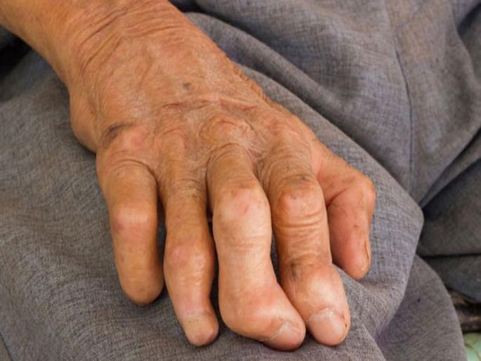 'Touch' awareness campaign for the release of leprosy in the state | राज्यात कुष्ठरोगमुक्तीसाठी 'स्पर्श' जनजागृती अभियान 'Touch' awareness campaign for the release of leprosy in the state | राज्यात कुष्ठरोगमुक्तीसाठी 'स्पर्श' जनजागृती अभियान