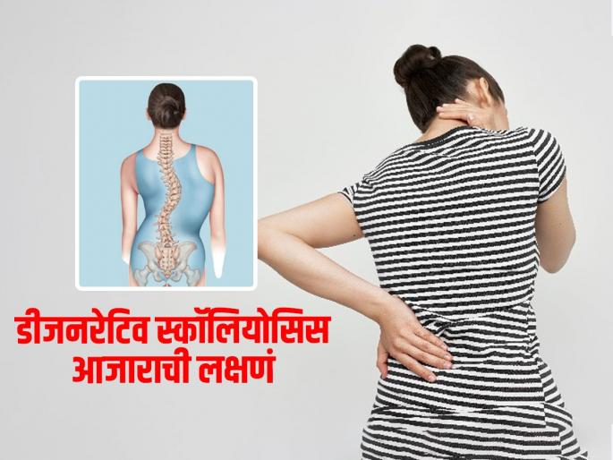 What is the spinal disease degenerative scoliosis know its symptoms | मणका वाकडातिकडा होणं, बाक येणं 'हा' आजार नेमका काय? वाचा लक्षणं आणि धोका टाळण्याचे उपाय