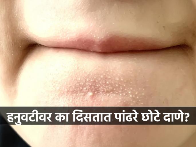 How to get rid of a chin pimple know from dermatologist chin pimple treatment how to remove chin acne dermatologist tips for chin pimples | हनुवटीवर पांढरे छोटे दाणे वारंवार येतात ? पाहा कारणे आणि उपाय, डर्मेटोलॉजिस्ट सांगतात, 'या' पद्धतीने करा साफ...