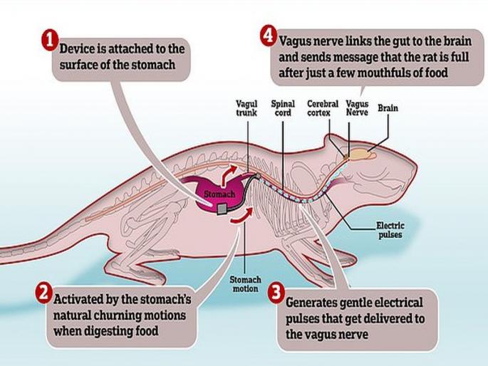 Scientists create 1cm device that help to reduce weight | एक असं डिवाइस जे पोटात लावल्यावर वजन होईल कमी! Scientists create 1cm device that help to reduce weight | एक असं डिवाइस जे पोटात लावल्यावर वजन होईल कमी!