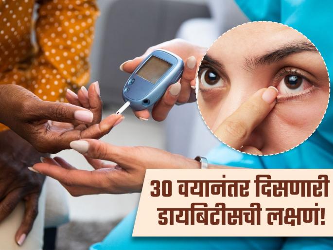 Symptoms of diabetes seen after the age of 30 years | ३० वयानंतर डायबिटीस झाल्यावर दिसतात 'ही' ३ लक्षणं, डोळ्यांपासून होते सुरूवात! Symptoms of diabetes seen after the age of 30 years | ३० वयानंतर डायबिटीस झाल्यावर दिसतात 'ही' ३ लक्षणं, डोळ्यांपासून होते सुरूवात!
