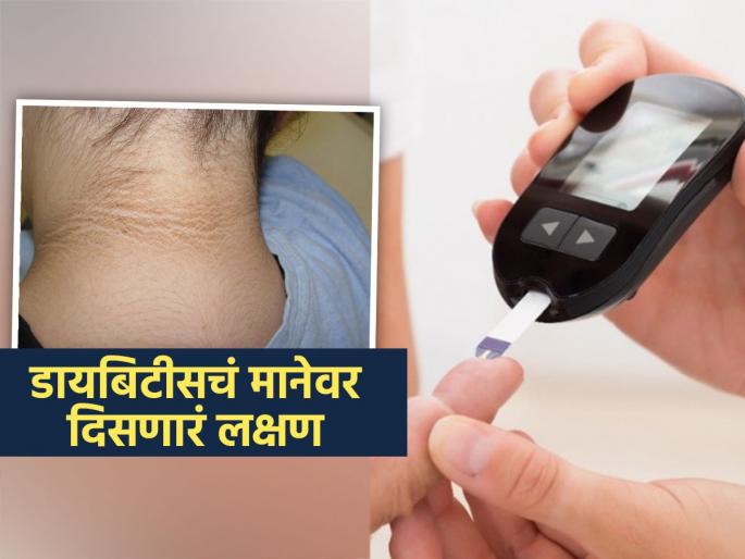 High blood sugar sign you can see on your neck | शुगर वाढल्याची लक्षणं ‘अशी’ दिसतात मानेवर, पाहा एकदा तुमची मान अशीच तर दिसत नाही?