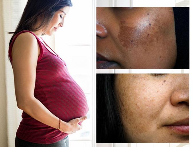 Discoloration During pregnancy is permanent or temporary? What does the doctor say? Narikaa | गरोदरपणात चेहरा काळवंडतो, त्वचेवर पडतात डाग.. हे कायमस्वरुपी की तात्पुरतं; डाॅक्टर काय म्हणतात?
