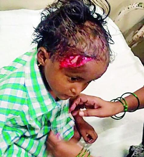 In Nagpur, dog bite to child , threatening life | नागपुरात कुत्र्याने डोके फोडलेल्या चिमुकलीचा जीव धोक्यात In Nagpur, dog bite to child , threatening life | नागपुरात कुत्र्याने डोके फोडलेल्या चिमुकलीचा जीव धोक्यात