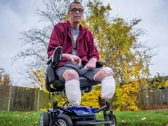 Pet dog killed his owner and attacked another man, both legs needs to cut after infection | पाळीव कुत्र्याने आधी मालकाला मारले, नंतर नातेवाईकालाही आपले दोन्ही पाय गमवावे लागले Pet dog killed his owner and attacked another man, both legs needs to cut after infection | पाळीव कुत्र्याने आधी मालकाला मारले, नंतर नातेवाईकालाही आपले दोन्ही पाय गमवावे लागले