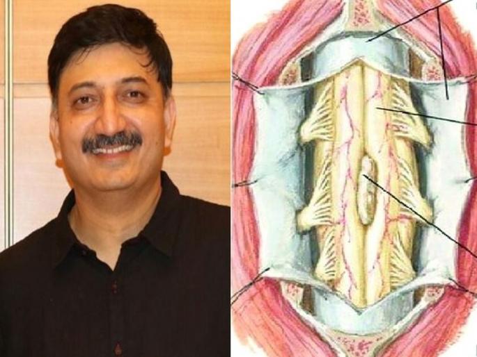 An enlarged bone in the spine of a three-year-old baby; Second case in the world | तीन वर्षांच्या बाळाच्या मणक्यात वाढले हाड; जगातील दुसरी केस An enlarged bone in the spine of a three-year-old baby; Second case in the world | तीन वर्षांच्या बाळाच्या मणक्यात वाढले हाड; जगातील दुसरी केस