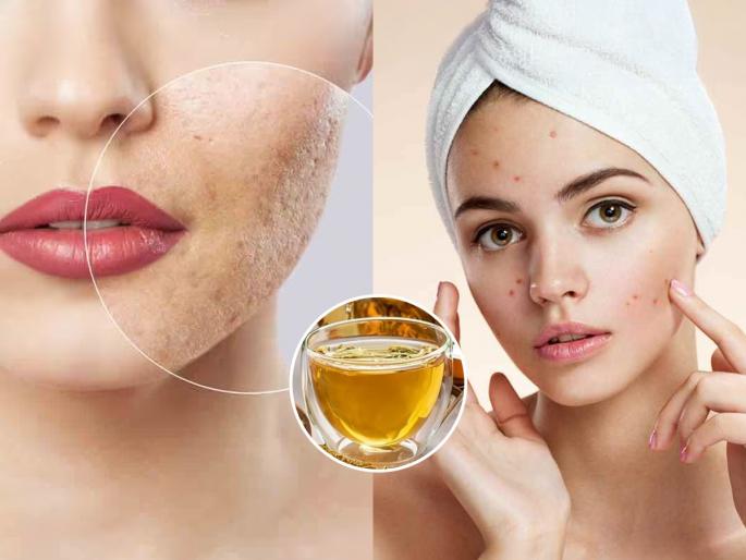 best ayurvedic drink to remove pimples and scars how to get glowing skin naturally in 1 month natural remedies for acne scars and clear skin | रात्री प्या खास आयुर्वेदिक ड्रिंक, पिंपल्स-फोडांचे डाग जातील- महिन्याभरात दिसेल जादू, त्वचाही उजळेल