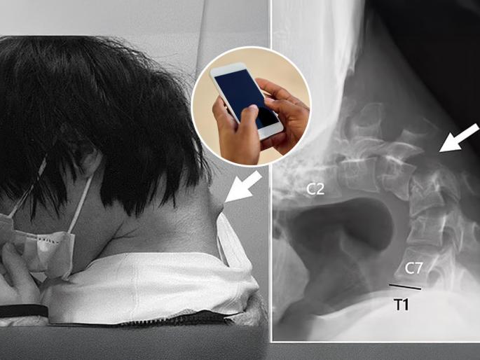 Drop Head Symdome: 25-year-old man's neck permanently bent due to looking at mobile phone, new disease developed | Drop Head Syndrome: सारखं मोबाईल बघितल्यामुळे २५ वर्षाच्या तरुणाची मान कायमची वाकली, जडला नवाच आजार