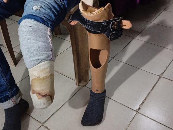 UP drug smuggler Salman Khan arrested in Nagpur: Drug smuggling with prosthetic legs | यूपीचा ड्रग तस्कर सलमान खान नागपुरात गजाआड : कृत्रिम पायातून करत होता ड्रग्जची तस्करी UP drug smuggler Salman Khan arrested in Nagpur: Drug smuggling with prosthetic legs | यूपीचा ड्रग तस्कर सलमान खान नागपुरात गजाआड : कृत्रिम पायातून करत होता ड्रग्जची तस्करी