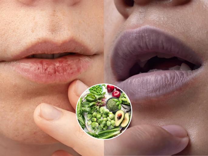 how to cure cracked lips due to vitamin deficiency natural remedies for dark lips in climate | ओठ फुटतात कारण ‘या’ दोन व्हिटामिन्सची कमतरता, ५ पदार्थ खा- ओठ होतील मऊ गुलाबी