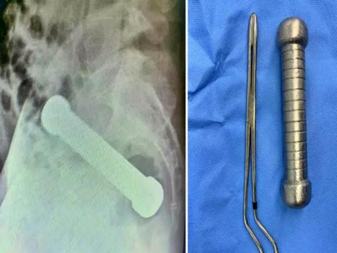 Brazil : Dumbbell stuck in man body reached doctor after 2 days | काय सांगता! प्रायव्हेट पार्टमध्ये अडकलं होतं २ किलोचं डम्बल, २ दिवसांनी हॉस्पिटलमध्ये पोहोचला आणि....