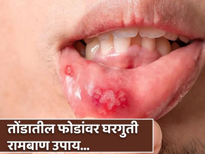 Natural Remedies to Cure Mouth Ulcers | तोंडातील फोडांमुळे काही खाता-पिताना होतो त्रास? लगेच करा हे घरगुती उपाय! Natural Remedies to Cure Mouth Ulcers | तोंडातील फोडांमुळे काही खाता-पिताना होतो त्रास? लगेच करा हे घरगुती उपाय!