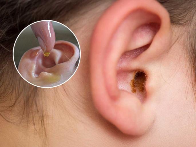 safe home remedies to remove earwax naturally what happens if you put oil in your ears how to clean earwax at home without damaging ears | कानातला मळ साफ करता? चुकूनही घालू नका तेल, व्हाल कायमचे बहिरे- ३ पद्धतीने साफ करा... safe home remedies to remove earwax naturally what happens if you put oil in your ears how to clean earwax at home without damaging ears | कानातला मळ साफ करता? चुकूनही घालू नका तेल, व्हाल कायमचे बहिरे- ३ पद्धतीने साफ करा...