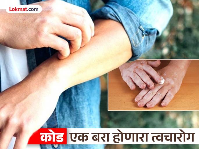 Remedy for eczema: With proper care, this skin disease can be completely cured! | कोडावर उपाय : योग्य काळजी घेतल्यास हा त्वचारोग होऊ शकतो पूर्णपणे बरा!