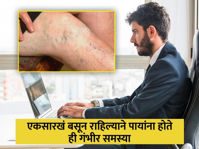 Sitting jobs can damage legs and cause varicose veins know how to make legs strong | सतत बसून काम केल्याने पायांना होईल ही गंभीर समस्या, डॉक्टरांनी सांगितले उपाय Sitting jobs can damage legs and cause varicose veins know how to make legs strong | सतत बसून काम केल्याने पायांना होईल ही गंभीर समस्या, डॉक्टरांनी सांगितले उपाय