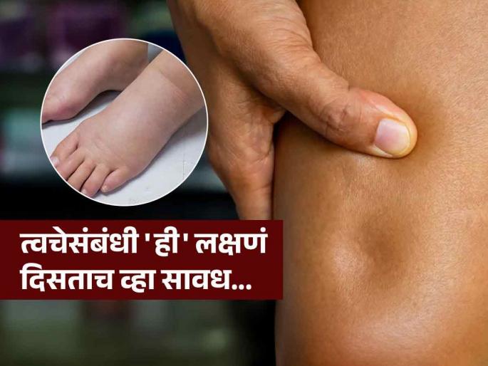 Pitting edema symptoms and swelling in foot skin causes | पायांवर सूज दिसते, बोट लावलं की खड्डा पडल्यासारखे दिसते? वाचा त्रास नेमका काय, धोका कशाचा