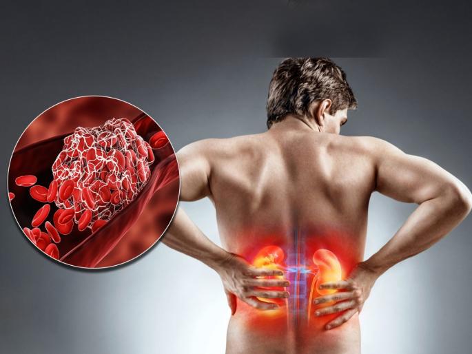 These are 6 symptoms of blood clotting in kidney or renal vein thrombosis | किडनीमध्ये रक्ताची गाठ तयार झाल्यावर दिसतात ही 6 लक्षणं, वेळीच व्हा सावध!