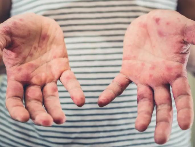 symptoms-of-measles-are-found-in-elders-also-in-gowandi-area-bmc-says-take-necessary-care | मुंबईकरांची चिंता वाढली, प्रौढांमध्येही गोवरची लक्षणे, दुर्लक्ष न करण्याचे आवाहन symptoms-of-measles-are-found-in-elders-also-in-gowandi-area-bmc-says-take-necessary-care | मुंबईकरांची चिंता वाढली, प्रौढांमध्येही गोवरची लक्षणे, दुर्लक्ष न करण्याचे आवाहन