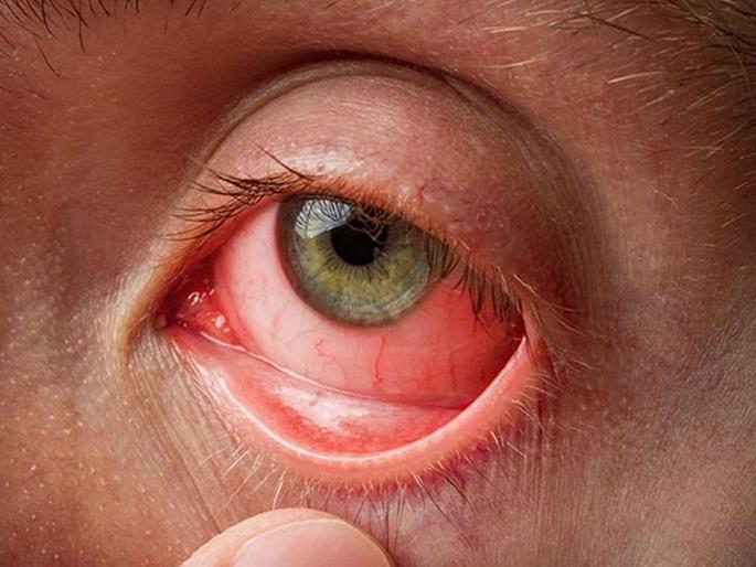 Five thousand people in Solapur are infected with the disease of 'eyes' | सोलापुरातील पाच हजार लोकांना ‘डोळे येणे’ आजाराची लागण Five thousand people in Solapur are infected with the disease of 'eyes' | सोलापुरातील पाच हजार लोकांना ‘डोळे येणे’ आजाराची लागण