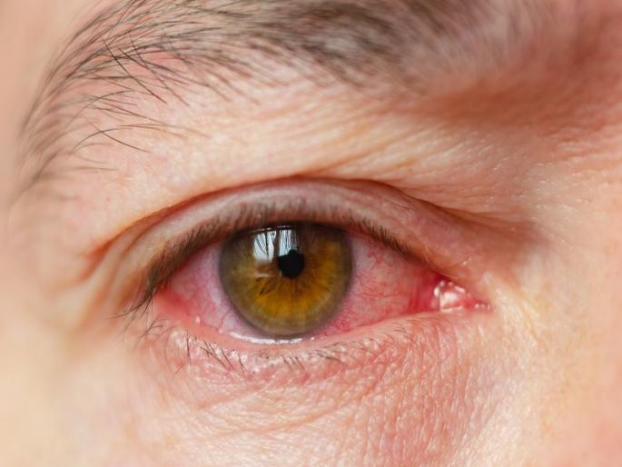 In the records of the Municipal Corporation, four and a half thousand people in Pune have eye support | PMC: पुण्यात डोळ्याची साथ वेगाने वाढतेय, साडेचार हजारांना बाधा; ३ हजार ड्रॉप पालिकेच्या दवाखान्यात In the records of the Municipal Corporation, four and a half thousand people in Pune have eye support | PMC: पुण्यात डोळ्याची साथ वेगाने वाढतेय, साडेचार हजारांना बाधा; ३ हजार ड्रॉप पालिकेच्या दवाखान्यात