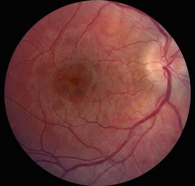 The 97-year-old grandmother died of cancer | ९७ वर्षांच्या आजींनी कॅन्सरला हरवले The 97-year-old grandmother died of cancer | ९७ वर्षांच्या आजींनी कॅन्सरला हरवले