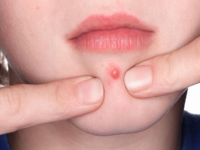 After popping a zit to prevent scarring what should you do | पुरळ किंवा पिंपल्स फोडल्यावर चेहऱ्यावर डाग पडणे कसे रोखाल? After popping a zit to prevent scarring what should you do | पुरळ किंवा पिंपल्स फोडल्यावर चेहऱ्यावर डाग पडणे कसे रोखाल?