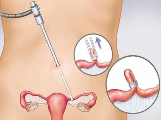 Leading women in sterilization surgery | नसबंदी शस्त्रक्रिया करण्यात महिला आघाडीवर Leading women in sterilization surgery | नसबंदी शस्त्रक्रिया करण्यात महिला आघाडीवर