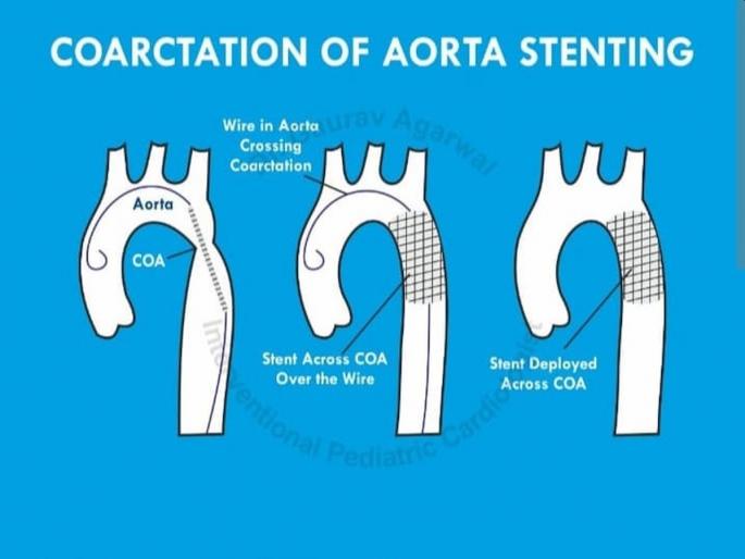 A toddler traveled 4600 km from Mauritius to Navi Mumbai for an emergency heart procedure | हृदयरोगावरील आपत्कालीन प्रक्रियेसाठी चिमुकल्याने केला मॉरिशस ते नवी मुंबई ४६०० किमीचा प्रवास A toddler traveled 4600 km from Mauritius to Navi Mumbai for an emergency heart procedure | हृदयरोगावरील आपत्कालीन प्रक्रियेसाठी चिमुकल्याने केला मॉरिशस ते नवी मुंबई ४६०० किमीचा प्रवास