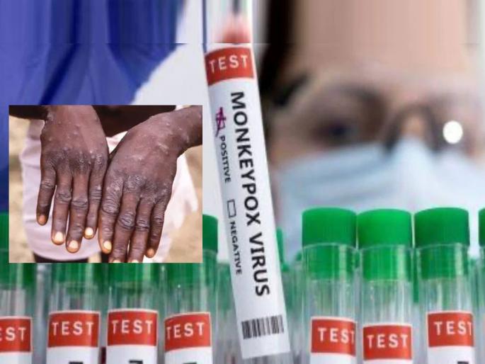 Sore throat, swelling on private parts know about the Monkeypox New Symptoms | चिंता वाढली! घसा खवखवणे, प्रायव्हेट पार्टवर सूज अन्...; मंकीपॉक्स रुग्णांमध्ये दिसून आली 'ही' नवी लक्षणं Sore throat, swelling on private parts know about the Monkeypox New Symptoms | चिंता वाढली! घसा खवखवणे, प्रायव्हेट पार्टवर सूज अन्...; मंकीपॉक्स रुग्णांमध्ये दिसून आली 'ही' नवी लक्षणं