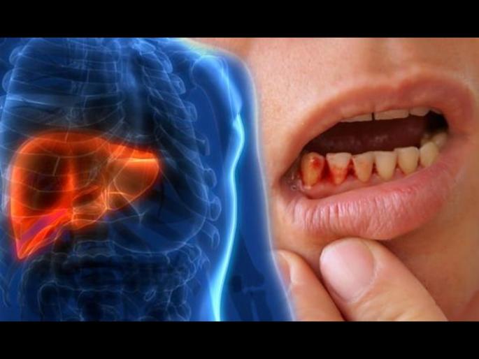 Gum bleeding while brushing teeth give sign of fatty liver disease | ब्रश करताना ही समस्या झाली तर तुम्हाला असू शकतो फॅटी लिव्हर डिजीज, वेळीच व्हा सावध