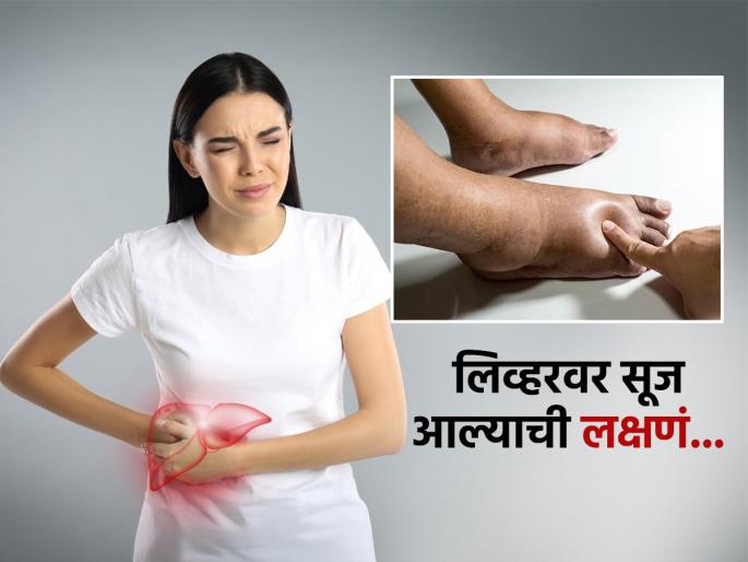 Swelling in these body parts means fatty liver is turning into cirrhosis, know the signs | पायांवर सूज, नखांमध्ये बदल दिसला तर वेळीच व्हा सावध, 'ही' आहेत लिव्हरमध्ये गडबड असल्याची लक्षणं..