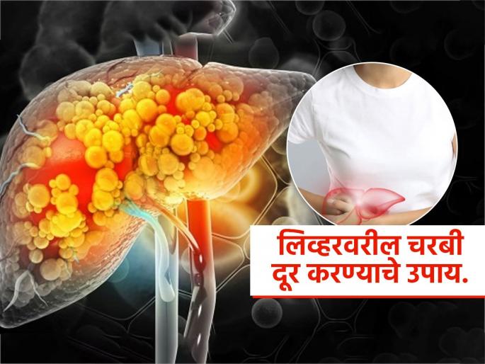 Dr Saurabh Sethi tells how to detox fatty liver | फॅटी लिव्हरसाठी आहारात करा ३ बदल, डॉक्टरांनी सांगितला खास उपाय-आहार ठरु शकेल औषध