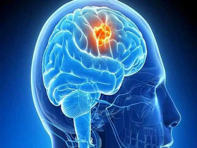 African youth overcome Kelly's brain tumor; Successful treatment at a private hospital | आफ्रिकेतील तरुणाने केली ब्रेन ट्युमरवर मात; खासगी रुग्णालयात यशस्वी उपचार African youth overcome Kelly's brain tumor; Successful treatment at a private hospital | आफ्रिकेतील तरुणाने केली ब्रेन ट्युमरवर मात; खासगी रुग्णालयात यशस्वी उपचार