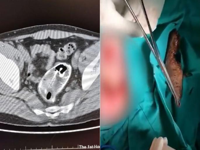 China doctors remove dead fish from mans rectum he said he sat on fish | हे असं कसं रे भौ! 'त्याच्या' मलाशयात शिरला 16 इंच लांबीचा मासा, उत्तर ऐकून डॉक्टर गेले 'कोमात'...