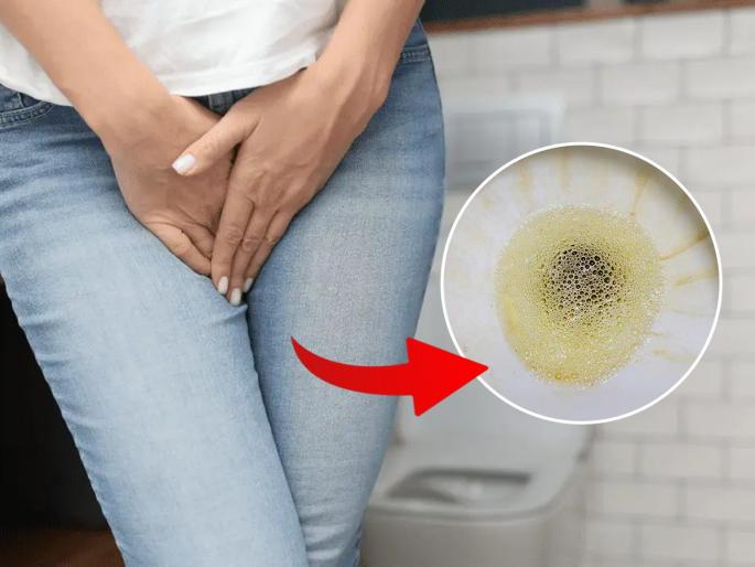 Health tips know the common causes of foamy urine treatment foamy urine causes & treatment | लघवीत भरपूर फेस दिसतो ? सेलिब्रिटी न्यूट्रिशनिस्ट सांगतात ७ उपाय - वेळीच द्या लक्ष, किडनी होईल खराब... Health tips know the common causes of foamy urine treatment foamy urine causes & treatment | लघवीत भरपूर फेस दिसतो ? सेलिब्रिटी न्यूट्रिशनिस्ट सांगतात ७ उपाय - वेळीच द्या लक्ष, किडनी होईल खराब...