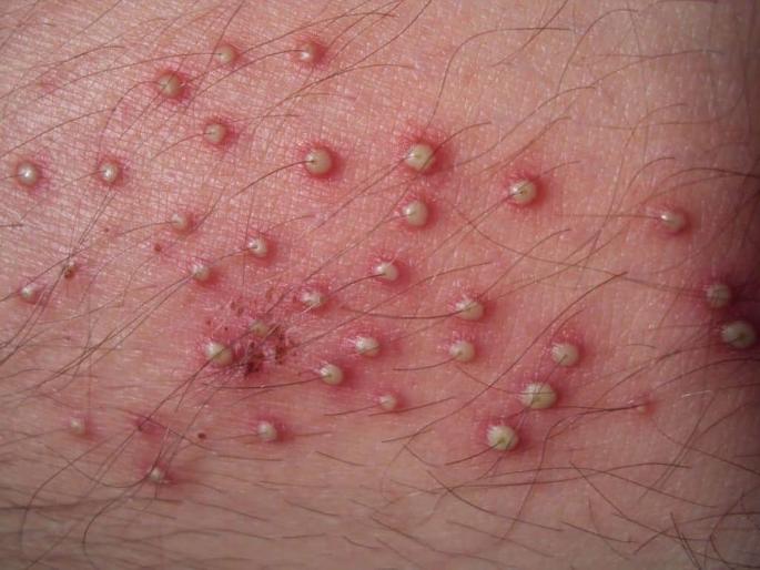 What is Folliculitis? know the Causes, symptoms, and treatment | काय आहे त्वचेवर होणारी फॉलिक्युलिटिस समस्या? जाणून घ्या लक्षणे आणि कारणे... What is Folliculitis? know the Causes, symptoms, and treatment | काय आहे त्वचेवर होणारी फॉलिक्युलिटिस समस्या? जाणून घ्या लक्षणे आणि कारणे...