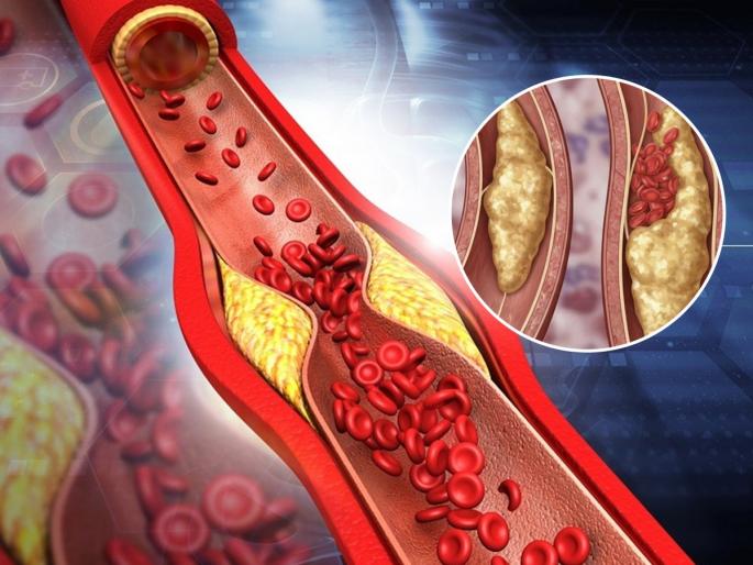 Food For Blocked Arteries Foods To Clean Arteries Naturally | रोज न विसरता खा ६ गोष्टी, नसांमध्ये ब्लॉकेज होणे टाळणे ते हातापायांना मुंग्या सगळ्यांवर सोपा उपाय... Food For Blocked Arteries Foods To Clean Arteries Naturally | रोज न विसरता खा ६ गोष्टी, नसांमध्ये ब्लॉकेज होणे टाळणे ते हातापायांना मुंग्या सगळ्यांवर सोपा उपाय...