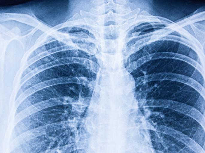 X-ray van detection of corona | एक्स-रे व्हॅनमार्फत कोरोनाबाधितांचा शोध X-ray van detection of corona | एक्स-रे व्हॅनमार्फत कोरोनाबाधितांचा शोध
