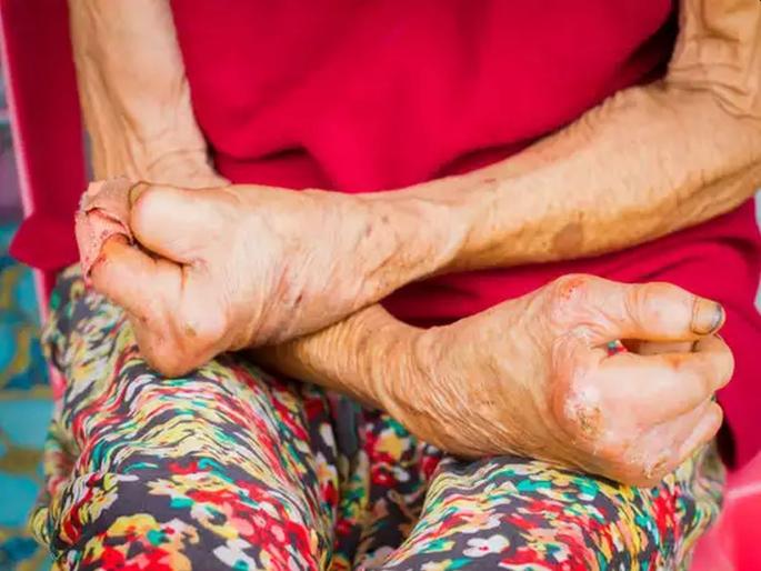 Leprosy, tuberculosis patient search campaign from tomorrow in the district akola | जिल्ह्यात उद्यापासून कुष्ठरोग, क्षयरोग रुग्ण शोध मोहीम! Leprosy, tuberculosis patient search campaign from tomorrow in the district akola | जिल्ह्यात उद्यापासून कुष्ठरोग, क्षयरोग रुग्ण शोध मोहीम!