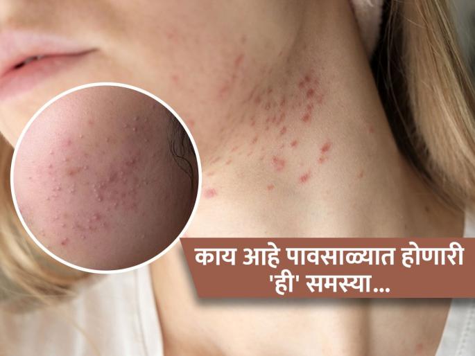 Fungal acne increases in the rain know the causes and symptoms | पिंपल्स नाही तुमच्या चेहऱ्यावरची ‘ही’ लक्षणं आहेत अधिक त्रासदायक, पाहा हा कोणता आजार