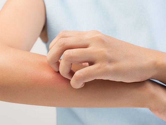 Home remedies to avoid fungal infection | डोक्यावर आणि त्वचेवर होणारं फंगल इन्फेक्शन दूर करण्याचे सोपे उपाय! Home remedies to avoid fungal infection | डोक्यावर आणि त्वचेवर होणारं फंगल इन्फेक्शन दूर करण्याचे सोपे उपाय!