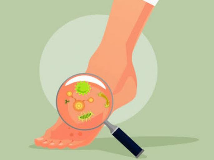 Colds increase the risk of 'fungal infections'! | थंडीमुळे वाढला ‘फंगल इन्फेक्शन’चा धोका! Colds increase the risk of 'fungal infections'! | थंडीमुळे वाढला ‘फंगल इन्फेक्शन’चा धोका!