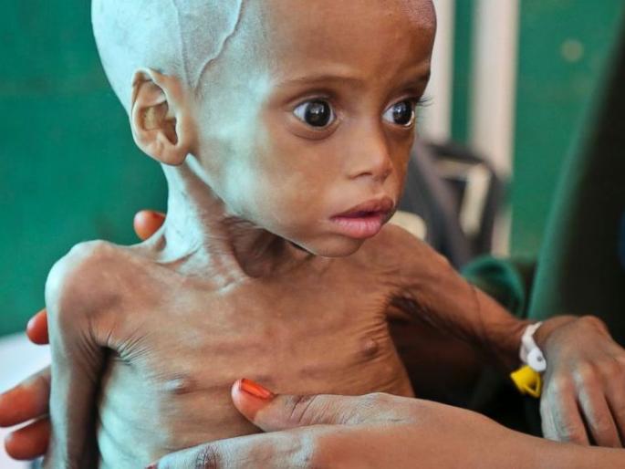 Malnutrition causes the highest mortality in the age group of 0 to 14 years | कुपोषणामुळे शून्य ते १४ वयोगटात सर्वाधिक मृत्यू