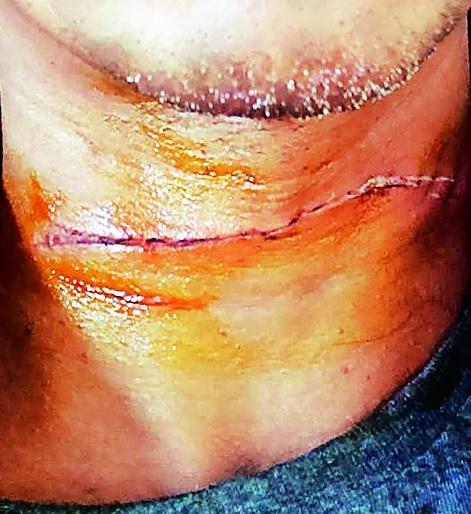 Teacher's throat cut by nylon thread of kite in Nagpur | नागपुरात नायलॉन मांजामुळे कापला शिक्षकाचा गळा; बचाव करताना बोटही चिरले